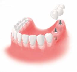 Implantate Elbezahnarzt Rainsborough Lüneburg / Hohnstorf