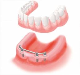Implantate Elbezahnarzt Rainsborough Lüneburg / Hohnstorf
