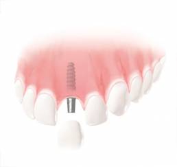 Implantate Elbezahnarzt Rainsborough Lüneburg / Hohnstorf